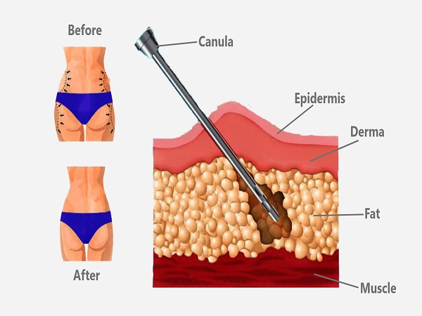Liposuction Surgery Cost in India