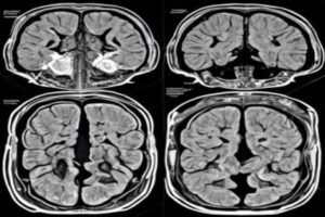 Amyotrophic Lateral Sclerosis