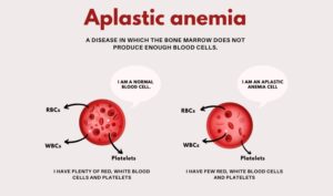 Aplastic Anemia Treatment