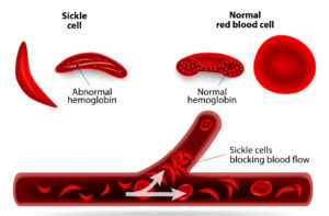Treatment of Sickle Cell Anemia